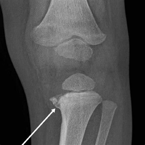 Bucket Handle Fracture Classical Metaphyseal Lesion Case Courtesy Of Download Scientific