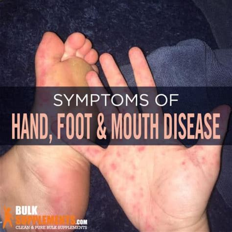 Hand Foot And Mouth Disease Hfmd Symptoms Causes And Treatment