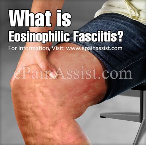 What Is Eosinophilic Fasciitiscausessymptomstreatmentprognosis