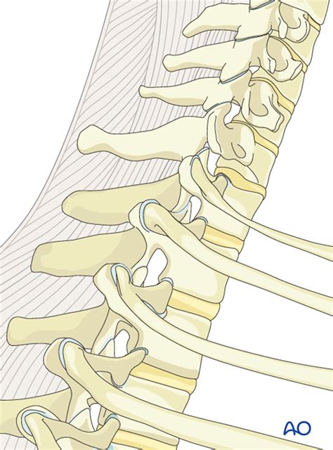 Cervicothoracic Junction Posterior Fixation For B2 Posterior Tension