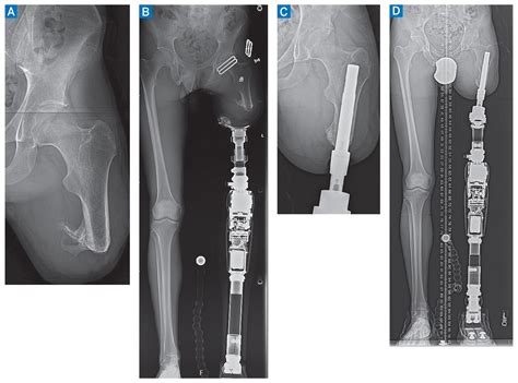 Transfemoral Osseointegration After Amputation Hss Case