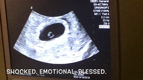 6 Week Ultrasound Are We Having Twins Youtube