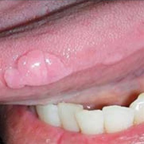 Two Separate Feh Lesions Of Left Lateral Tongue Border Download