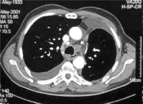 Computed Tomography In Staging For Lung Cancer European Respiratory