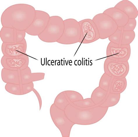 Ulcerative Colitis Causes Symptoms Colonoscopy Com