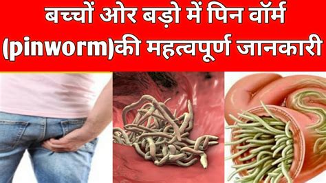 Worm Infection Symptoms Pinworm Infestation