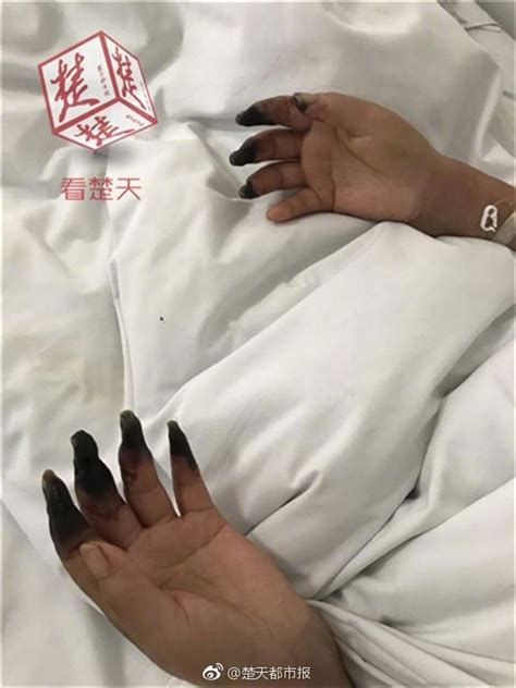 Woman Horrified As Eight Of Her Fingers Turn Black After Doing