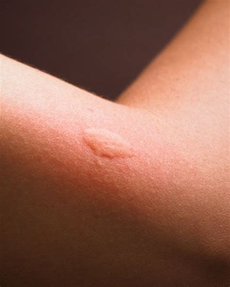 Pictures Of Spider Bites On Arm Debsartliff