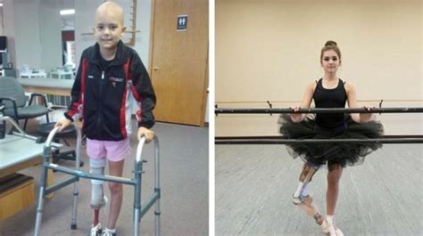 Voyez Ce Quest Devenue Cette Jeune Ballerine Amputée à Cause Du Cancer