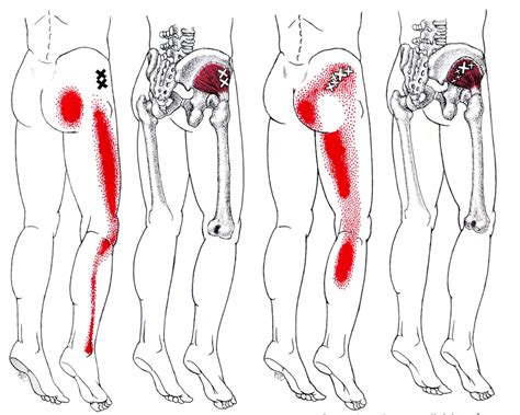 The superficial back muscles are the muscles found just under the skin. Lateral leg pain, more than just the IT Band — Revo ...