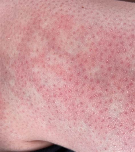 Mottled Skin Causes Symptoms Diagnosis And Treatment