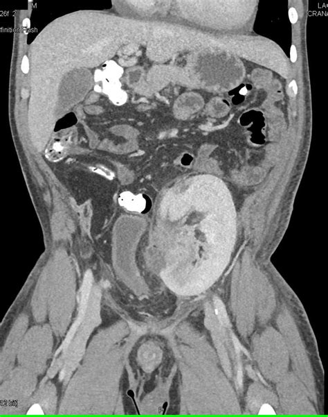 Acute Pyelonephritis In A Transplant Kidney Kidney Case Studies