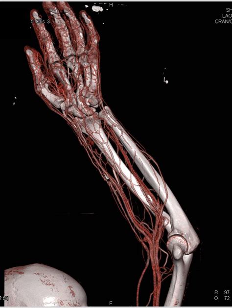 Abscess In Forearm With Cta And 3d Musculoskeletal Case Studies