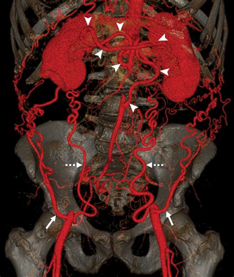 Agenesis Of Infrarenal Abdominal Aorta And Iliac Arteries Radiology