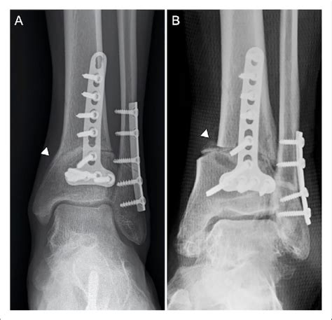 Depending On The Shape Of The Dome Osteotomy Simultaneous Adjustment