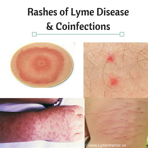 Lyme Disease Early Disseminated Pictures