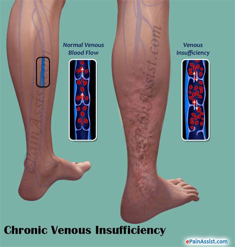 Pathophysiology Of Venous Insufficiency