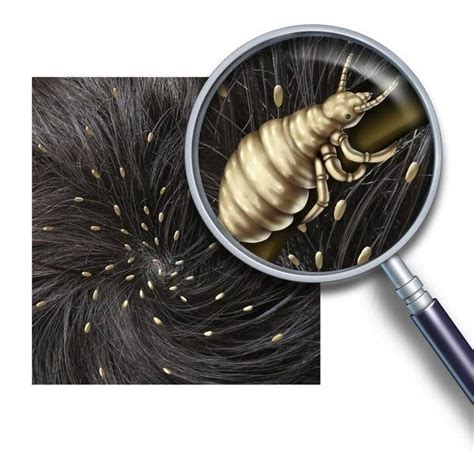 Are Selfies Really Causing The Spread Of Head Lice In Teens