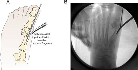 Radiographic Outcomes Of A Percutaneous Reproducible Distal Metatarsal Osteotomy For Mild And