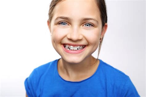 Two Phase Orthodontic Treatment Oxnard Orthodontics Dr Jared Lee