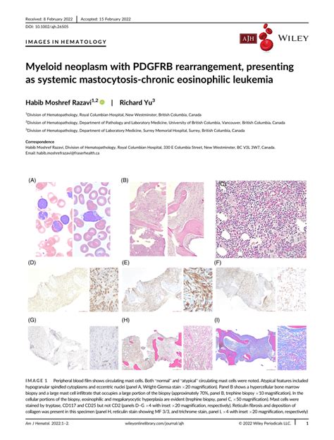 Myeloid Neoplasm With Pdgfrb Rearrangement Presenting As Systemic Mastocytosis‐chronic