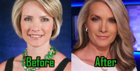 Dana Perino Plastic Surgery Facelift Nose Job Before After
