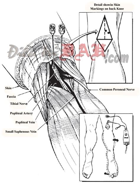 Common Peroneal Nerve Block At The Knee Pain Management