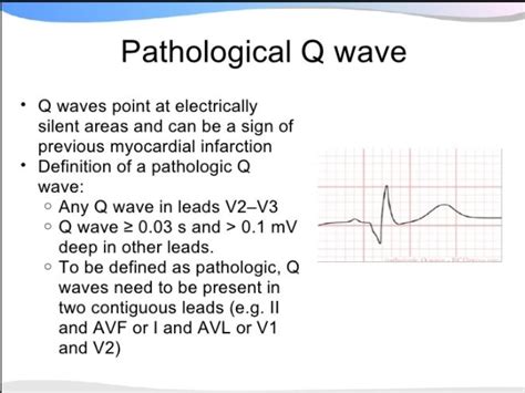 Q Waves Waves Cardiac Rhythms Pathology