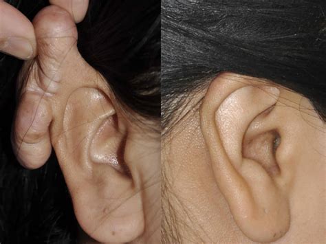 Ear Keloid Surgery Mehta Plastic Surgery