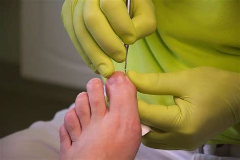Ingrown Toenail Trouble Ankle And Foot Centers Of Georgia West Cobb