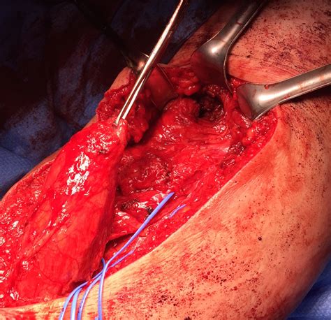 Proximal Hamstring Tear The Bone School