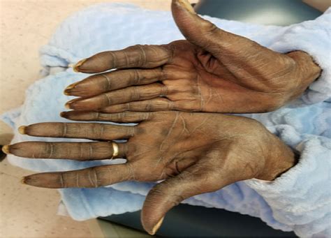 Cureus Hyperpigmentation With Capecitabine Part Of Hand Foot