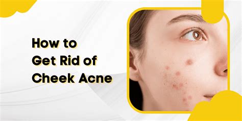 How To Get Rid Of Cheek Acne 2022