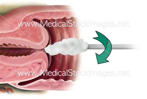 Smear Test Cervical Screening Medical Stock Images Company