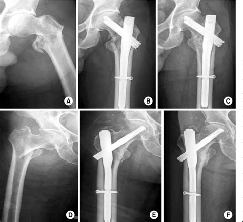 Pdf A Comparative Study Of Trigen™ Intertan Nail Intertan And