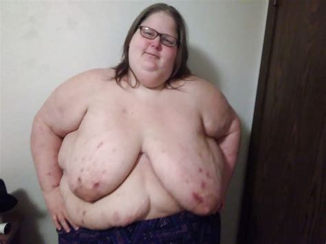 SSBBW REALITY Discolored Skin Scars Bedsores Acne Pics XHamster