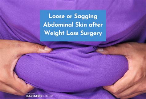Loose Abdominal Skin After Bariatric Surgery New Jersey Bariatric Center