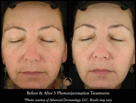 Photorejuvenation Ipl Treatments Chicago Advanced Dermatology