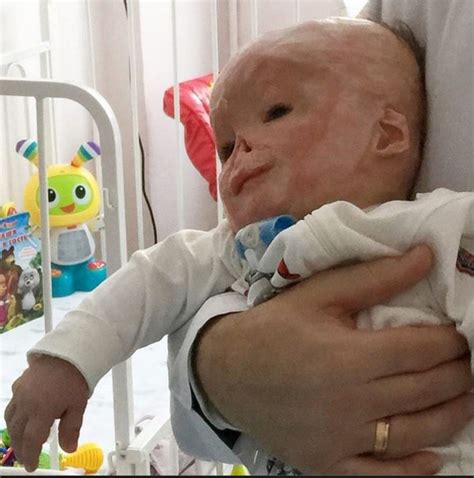 Baby Matvey Zakharenko Severely Burned Rejected By Mom