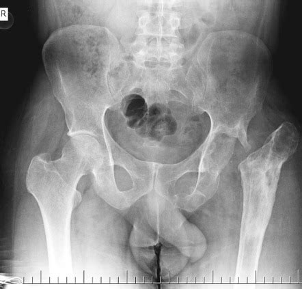 Chronic Osteomyelitis Radiology Reference Article Radiopaedia Org