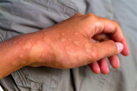 New Molecule Could Improve Treatments For Inflammatory Diseases Uq