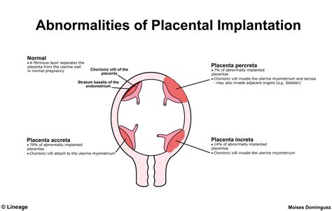 Placenta previa is a condition where the placenta lies low in the uterus and partially or completely covers the cervix. Placenta Accreta - Obstetrics - Medbullets Step 2/3