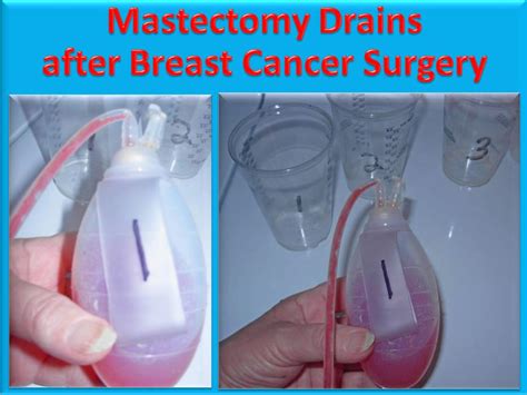 Ask Dj Lyons Video Tutorial How To Empty Mastectomy Drain Bottles