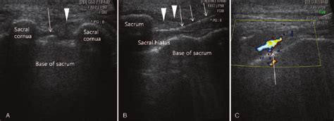 Ultrasound Guided Caudal Epidural Steroid Injection A Download