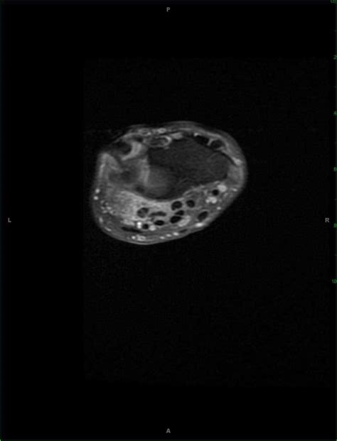 Giant Cell Tumor Of The Tendon Sheath Hand Body Mr Case Studies