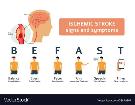 Ischemic Stroke Signs And Symptoms Medical Vector Image