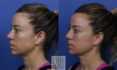 Dermal Fillers Before And After Pictures Case 422 Torrance Ca