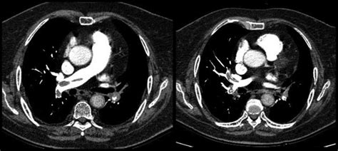 Values Of Thoracic Contrast‑enhanced Computed Tomography In Detecting