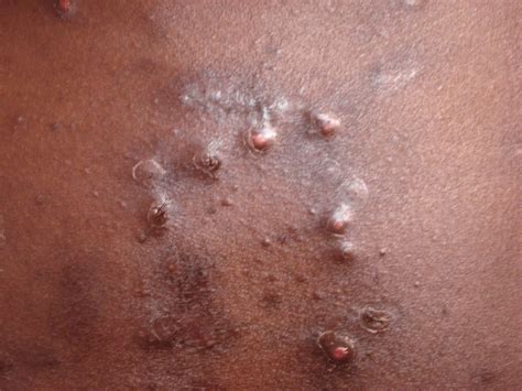 You must keep in mind that the scars should scars may slightly fade over time but are permanent. Healing Scar After Hysterectomy Incision