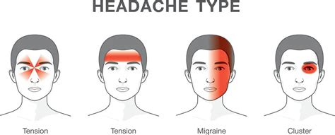 Treating Tension Headaches Trigger Point Therapy Artofit